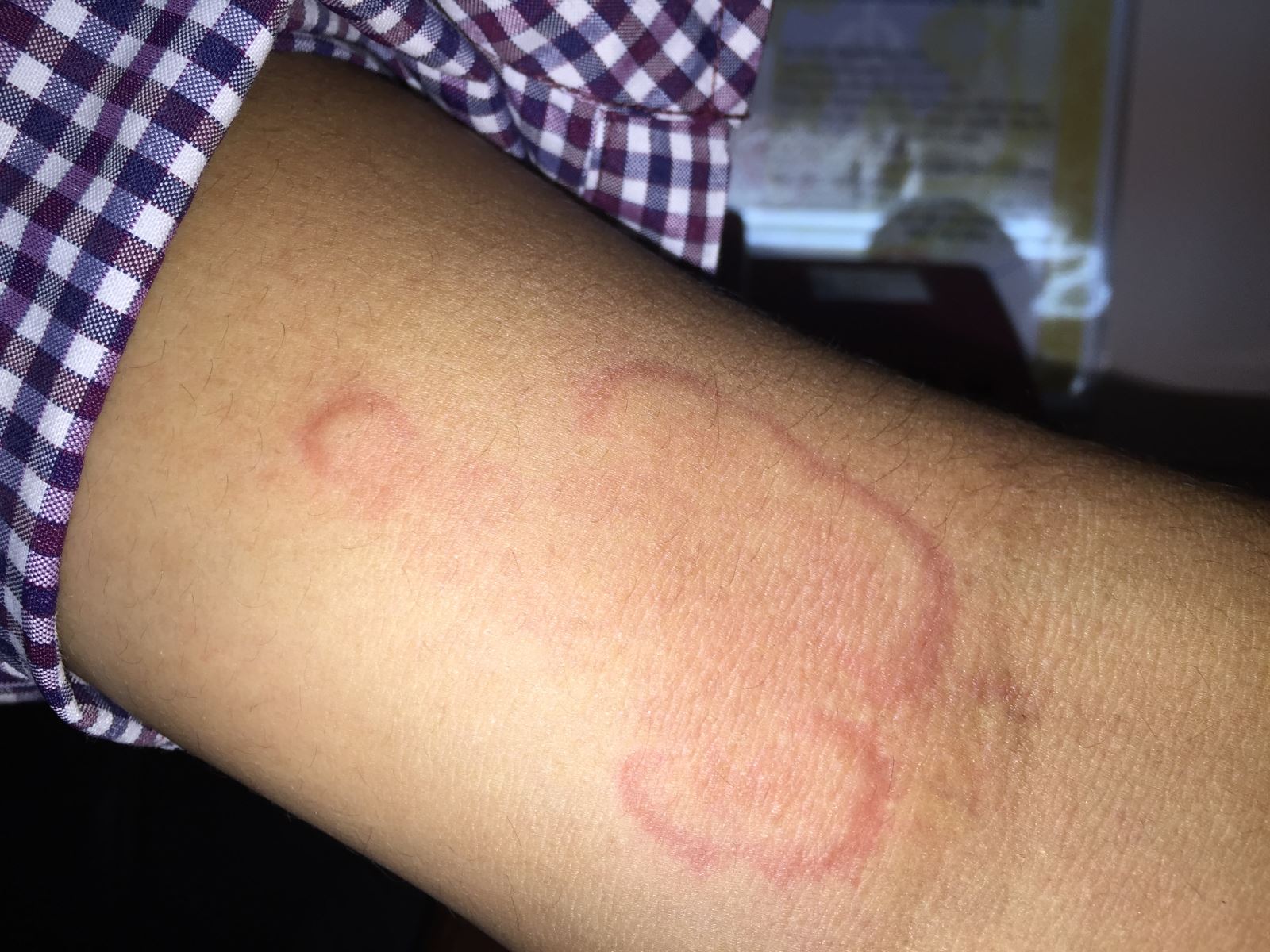 Nhiễm sán kim - Hình ảnh minh họa